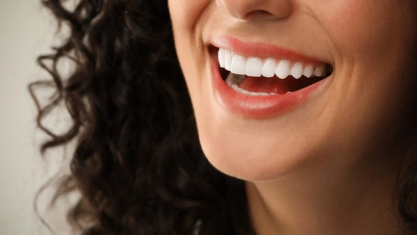  Dental Veneers