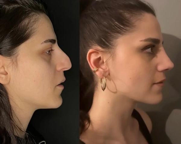 Giray  Genc Rinoplastika (Burun əməliyyatı) results in Turkey – case 198