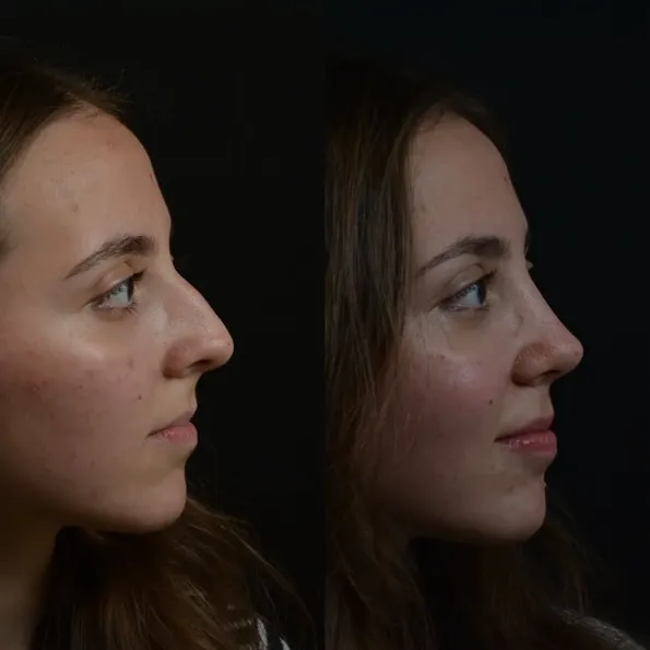 Rinoplastika (Burun əməliyyatı) əməliyyatı əvvəl və sonra nəticələr Türkiyə – hal 23
