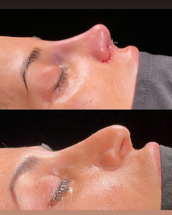 Yunus Kaplan Rinoplastika (Burun əməliyyatı) results in Turkey – case 31