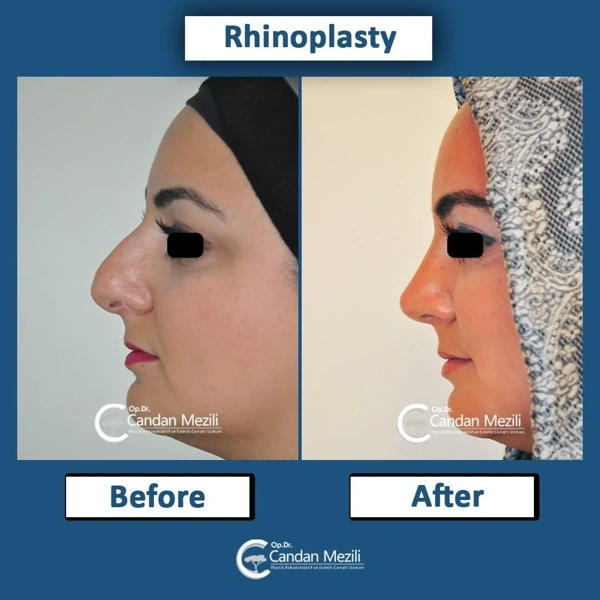 Candan Mezili Rinoplastika (Burun əməliyyatı) results in Turkey – case 441