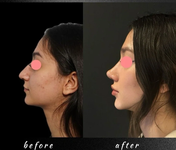 Duran Cekic Rinoplastika (Burun əməliyyatı) results in Turkey – case 633