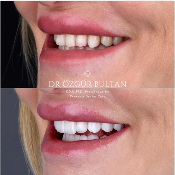 Ozgur  Bultan Diş laminatları results in Turkey – case 337