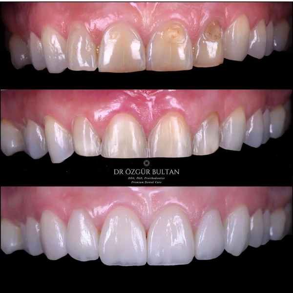 Ozgur  Bultan Diş laminatları results in Turkey – case 339