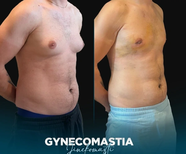 Kamil Manav Jinekomastiya əməliyyatı results in Turkey – case 553
