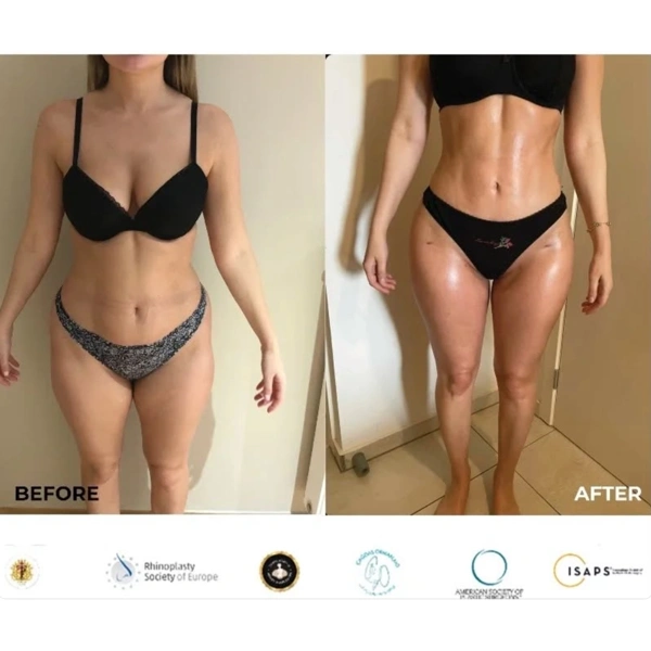 Cagdas Orman Liposaksiya results in Turkey – case 689