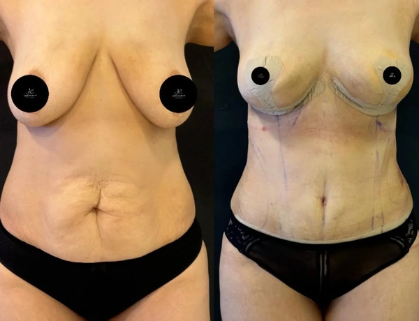 Ali Cem Oktay Mommy Makeover results in Turkey – case 67
