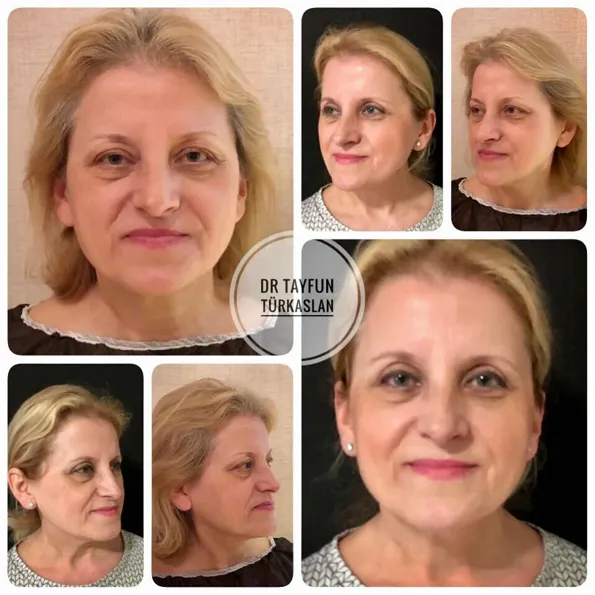 Üz gərmə əməliyyatı əməliyyatı əvvəl və sonra nəticələr Türkiyə – hal 48