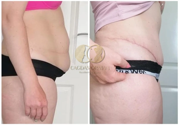 Cagdas Orman Bauchdeckenstraffung (Abdominoplastik) results in Turkey – case 182