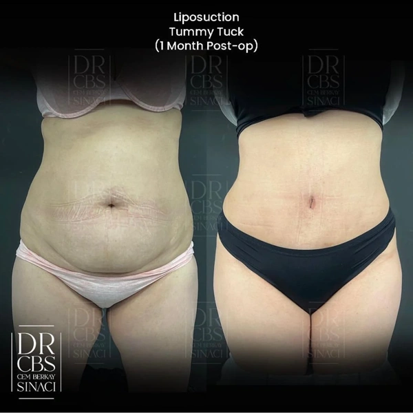 Bauchdeckenstraffung (Abdominoplastik) Vorher-nachher-Galerie – Weiblich Fall 317