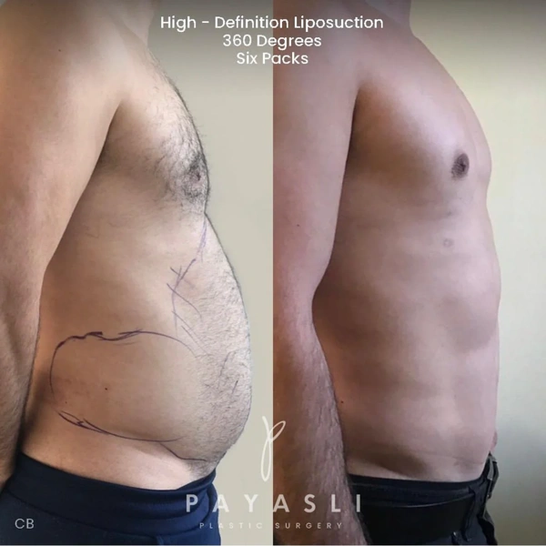 Cem Berkay  Sinaci Bauchdeckenstraffung (Abdominoplastik) results in Turkey – case 320