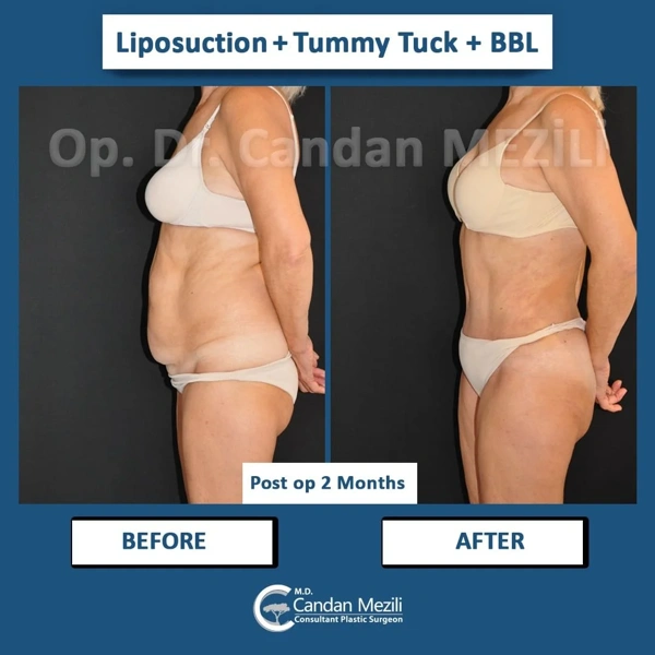 Candan Mezili Bauchdeckenstraffung (Abdominoplastik) results in Turkey – case 453