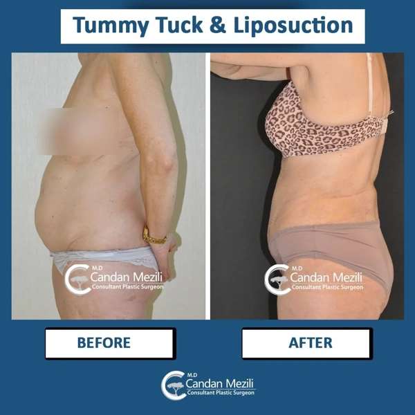Bauchdeckenstraffung (Abdominoplastik) Vorher-nachher-Galerie – Weiblich Fall 454
