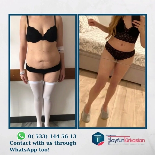 Bauchdeckenstraffung (Abdominoplastik) Vorher-nachher-Galerie – Weiblich Fall 45