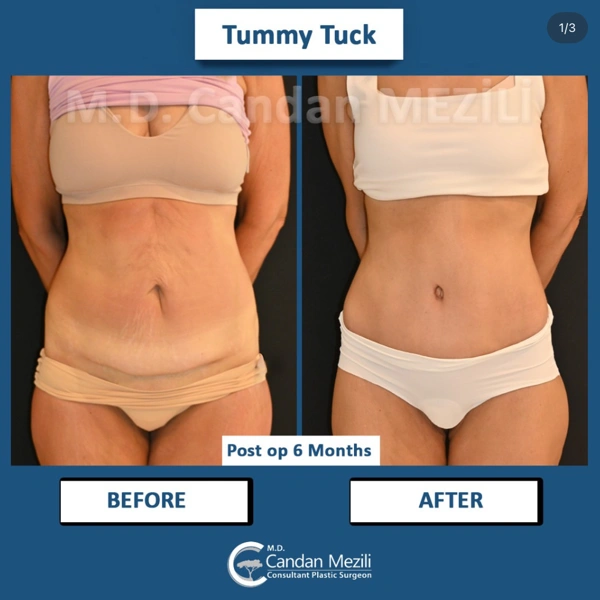 Candan Mezili Bauchdeckenstraffung (Abdominoplastik) results in Turkey – case 598