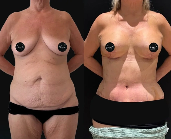 Kamil Manav Bauchdeckenstraffung (Abdominoplastik) results in Turkey – case 657