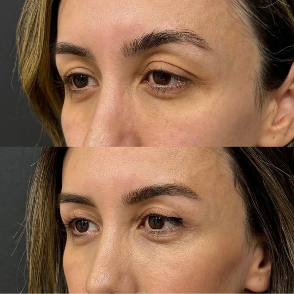 Blepharoplastik (Augenlidstraffung) Vorher-nachher-Galerie – Weiblich Fall 322