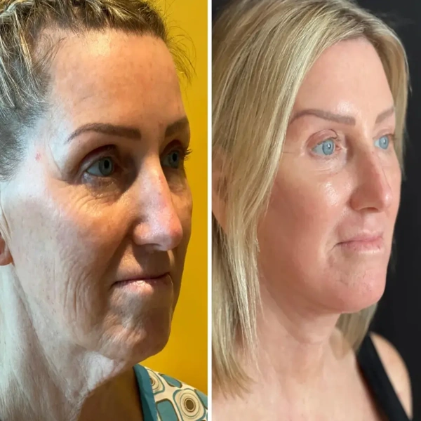Blepharoplastik (Augenlidstraffung) Vorher-nachher-Galerie – Weiblich Fall 607