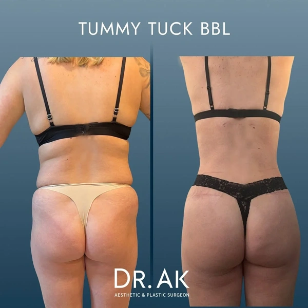 Erman Ak BBL (Brasilianisches Po-Lifting) results in Turkey – case 7