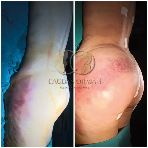 Cagdas Orman BBL (Brasilianisches Po-Lifting) results in Turkey – case 161