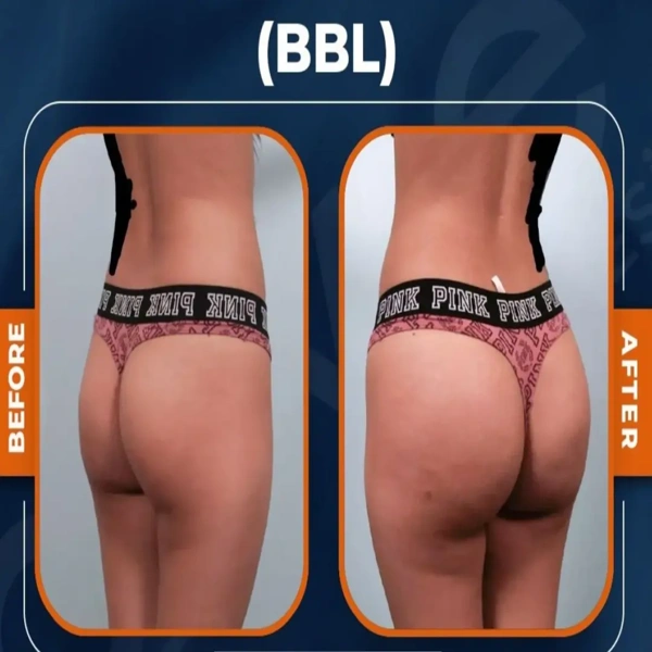 Ali Cem Oktay BBL (Brasilianisches Po-Lifting) results in Turkey – case 622