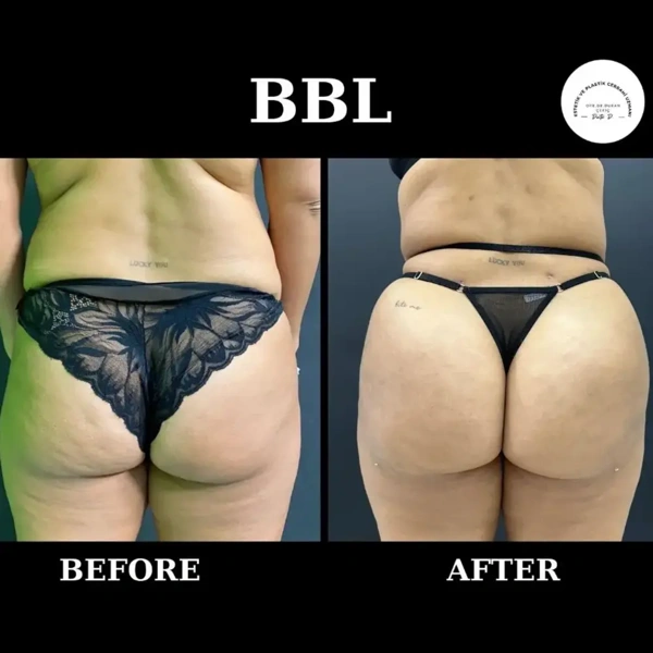 Duran Cekic BBL (Brasilianisches Po-Lifting) results in Turkey – case 634