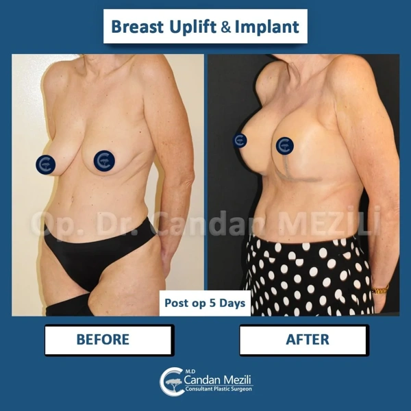 Candan Mezili Bruststraffung results in Turkey – case 473