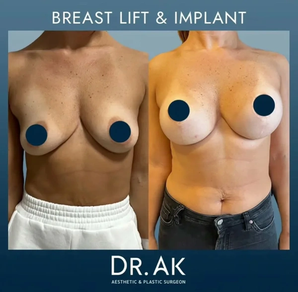 Erman Ak Bruststraffung results in Turkey – case 604