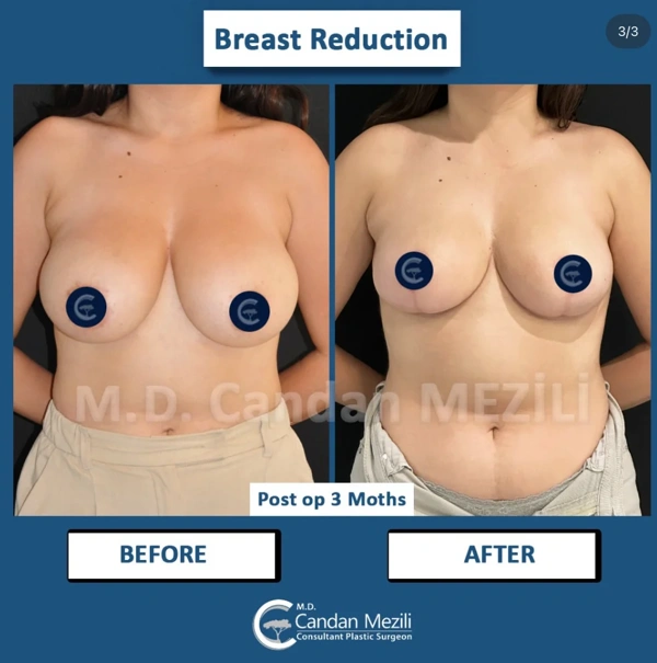 Candan Mezili Brustverkleinerung results in Turkey – case 589