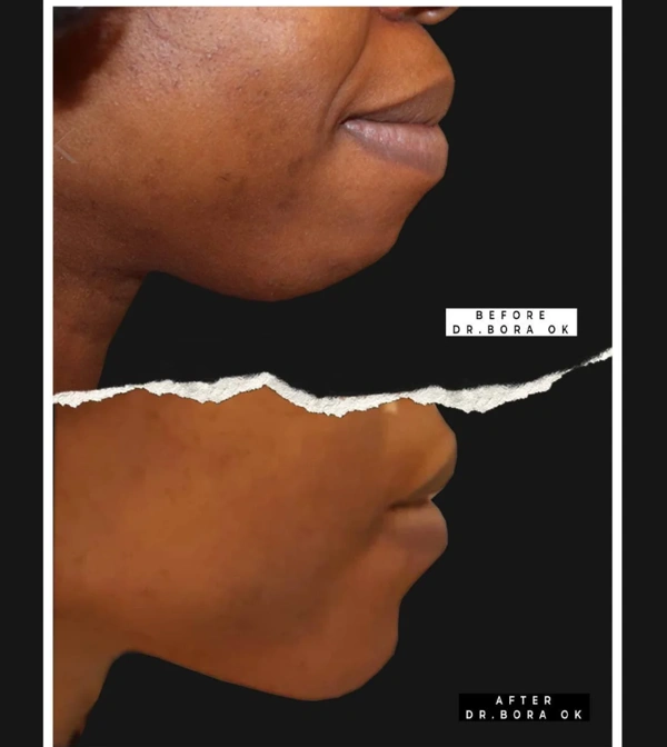 Bora  Ok Facelifting results in Turkey – case 153
