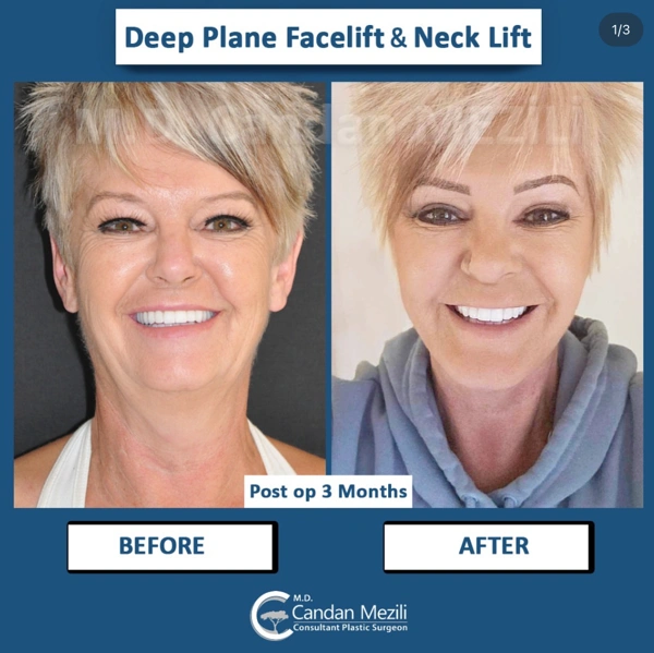 Candan Mezili Facelifting results in Turkey – case 573