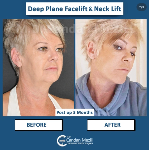 Candan Mezili Facelifting results in Turkey – case 574