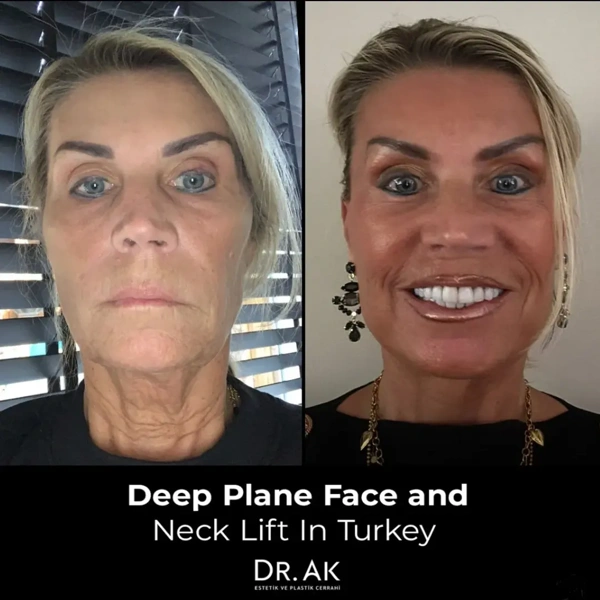 Erman Ak Facelifting results in Turkey – case 610