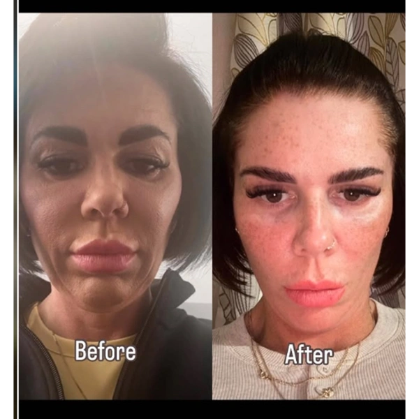 Cagdas Orman Facelifting results in Turkey – case 685