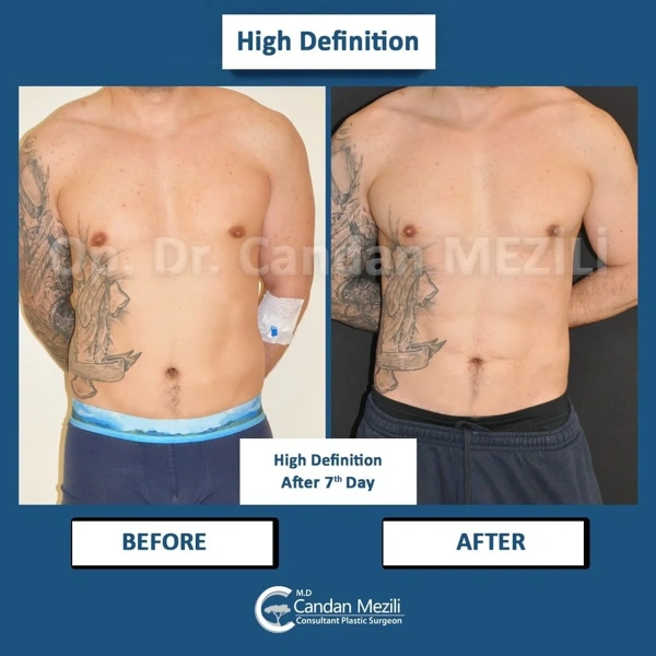 Candan Mezili Fettabsaugung results in Turkey – case 458