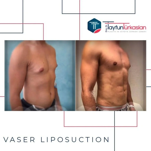 Tayfun Turkaslan Fettabsaugung results in Turkey – case 46