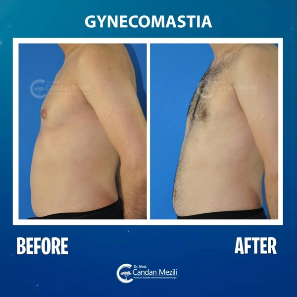 Candan Mezili Gynäkomastie-Chirurgie results in Turkey – case 449