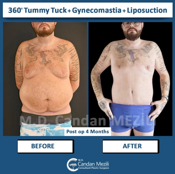 Candan Mezili Gynäkomastie-Chirurgie results in Turkey – case 590