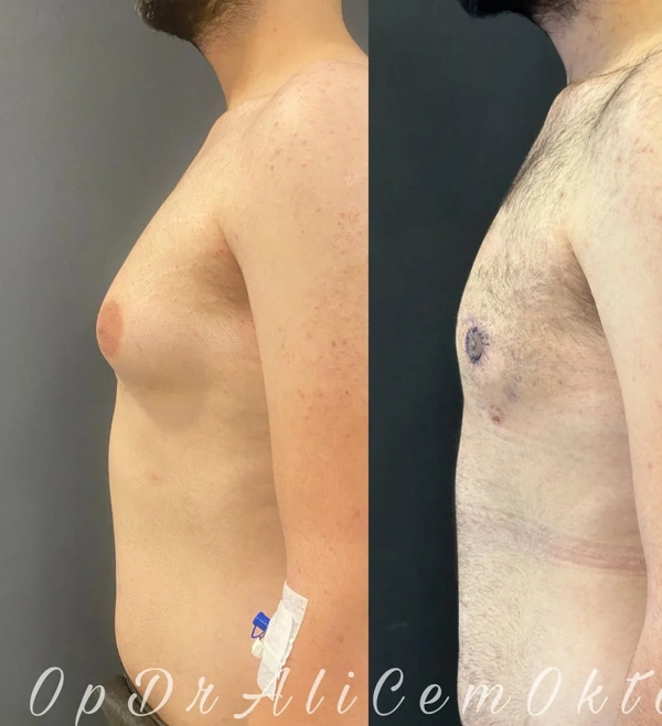 Ali Cem Oktay Gynäkomastie-Chirurgie results in Turkey – case 65
