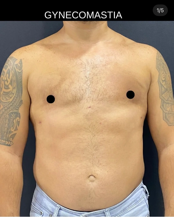 Duran Cekic Gynäkomastie-Chirurgie results in Turkey – case 86