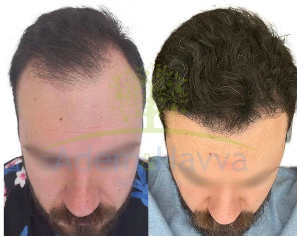 Haartransplantation Vorher-nachher-Galerie – Männlich Fall 99