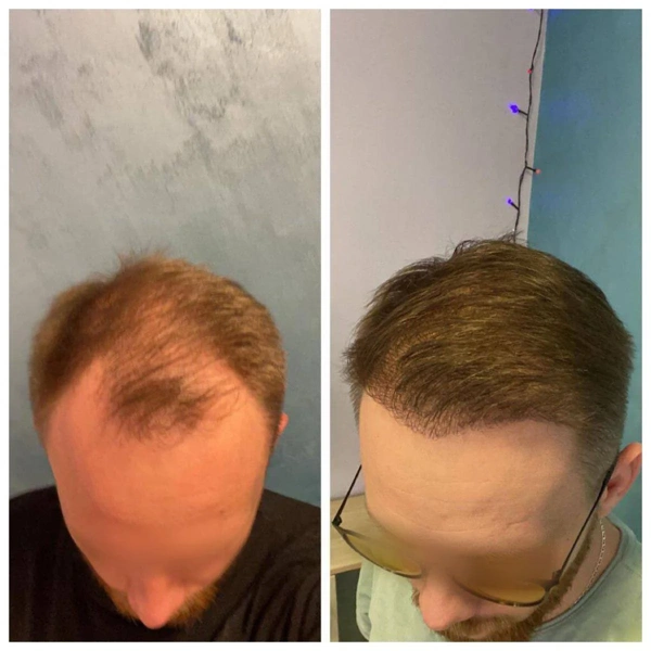 Haartransplantation Vorher-nachher-Galerie – Männlich Fall 101