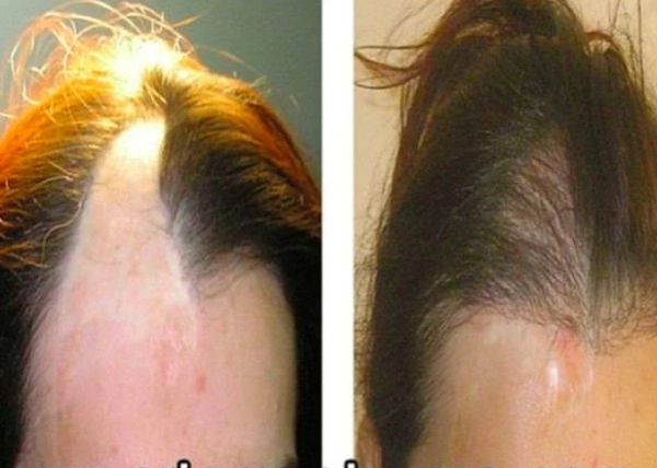 Ilayda  Yuceturk Haartransplantation results in Turkey – case 103