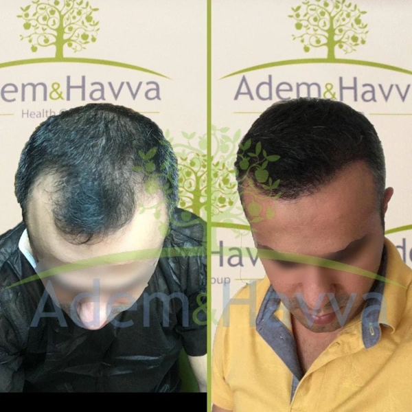 Ilayda  Yuceturk Haartransplantation results in Turkey – case 104
