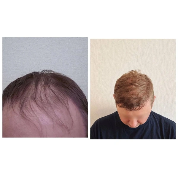 Ilayda  Yuceturk Haartransplantation results in Turkey – case 106