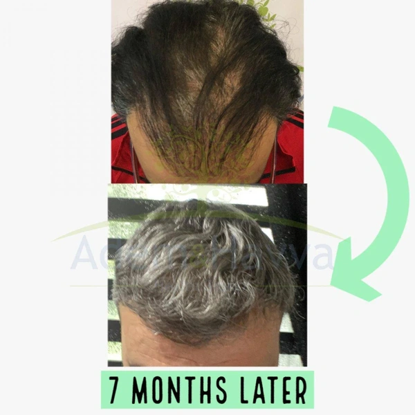 Haartransplantation Vorher-nachher-Galerie – Männlich Fall 108