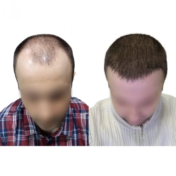 Ilayda  Yuceturk Haartransplantation results in Turkey – case 112