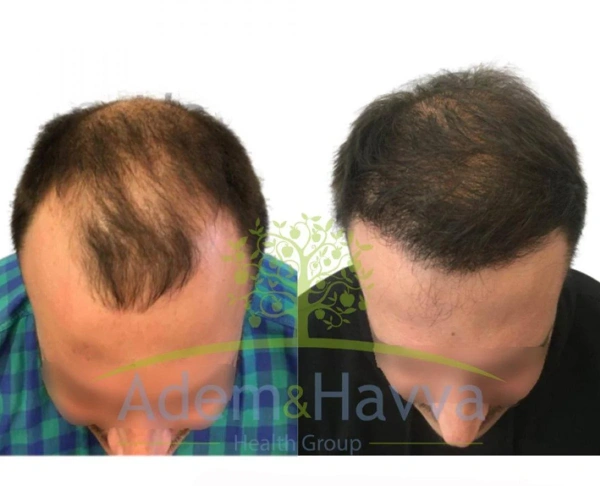 Ilayda  Yuceturk Haartransplantation results in Turkey – case 116