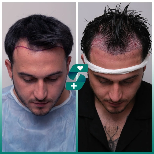 Haartransplantation Vorher-nachher-Galerie – Männlich Fall 515