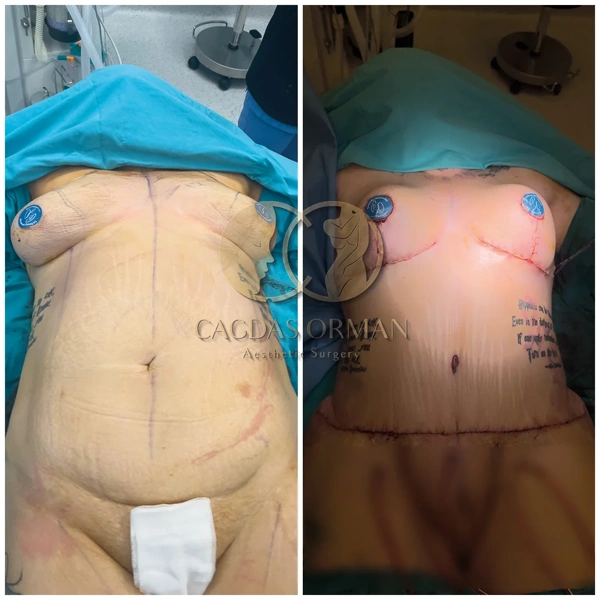 Mama-Makeover Vorher-nachher-Galerie – Weiblich Fall 184